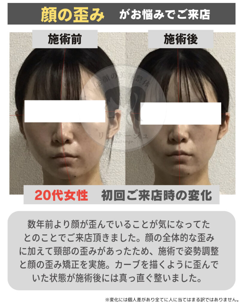 顔の歪み矯正は効果ある？左右差の原因とセルフケア・施術の全貌