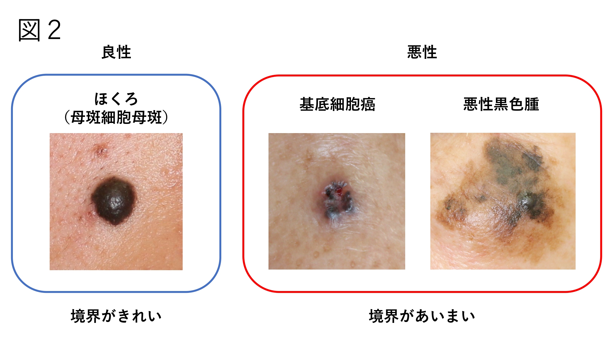 ほくろ除去後のテープはいつまで？跡を残さない正しい貼り方とケア