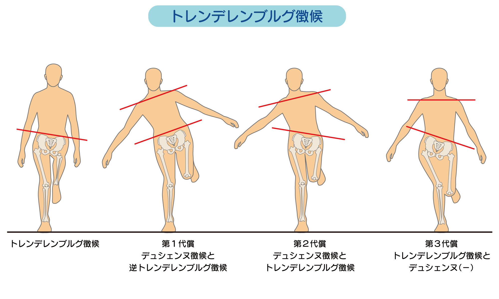 トレンデレンブルグ歩行の原因とリハビリ｜骨盤の傾きと中殿筋の真実