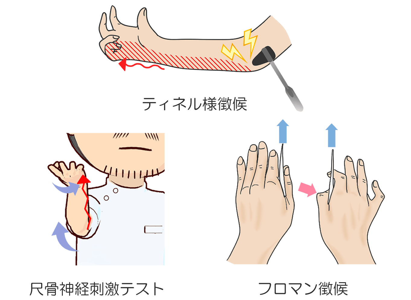 スマホ中の小指・薬指のしびれは危険？肘部管症候群の真相と治し方