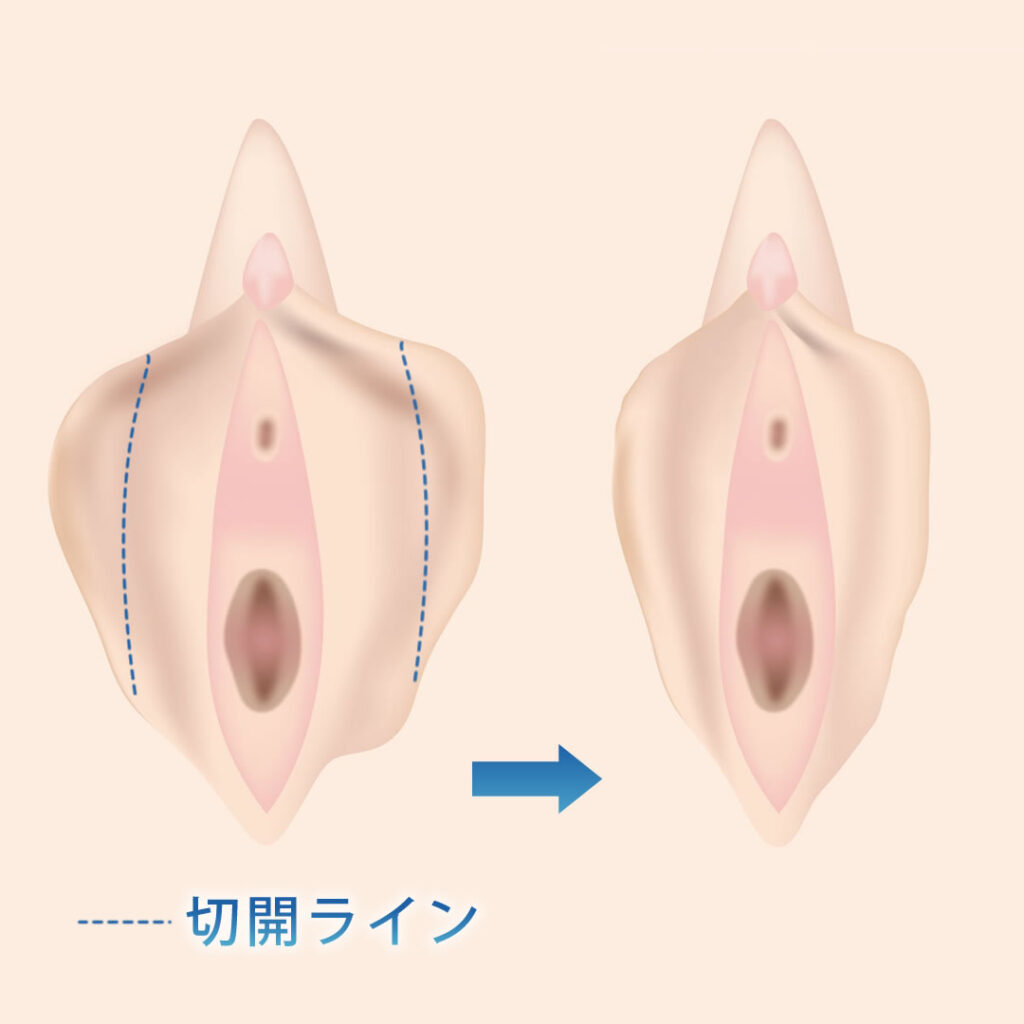 ビラビラの大きさ平均は何Cm？はみ出る原因と黒ずみの真相を徹底解説