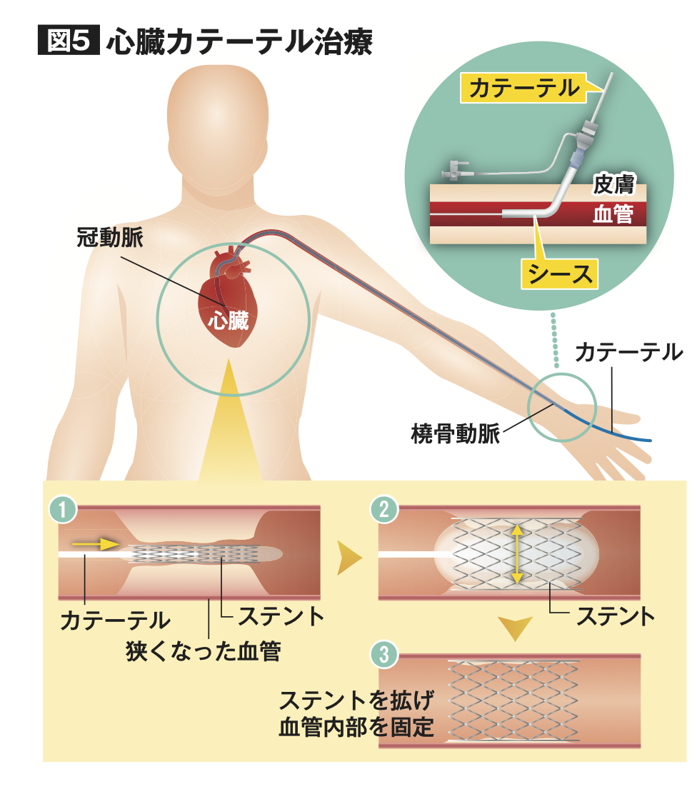カテーテル手術とは？体への負担が少ない理由と痛みの真相【2026】