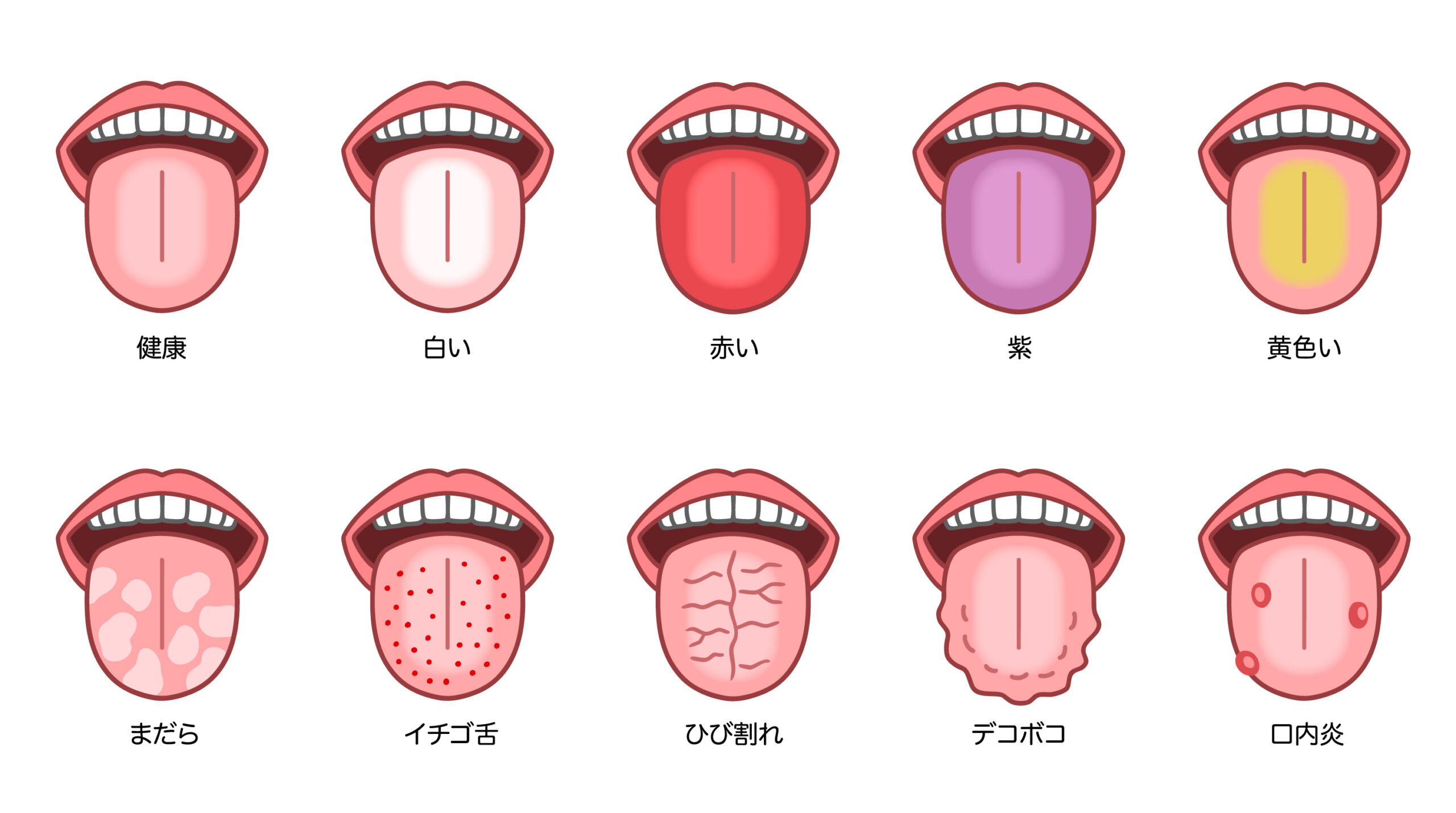 舌でわかる病気画像を徹底比較！白・赤・黒の変色と危険な受診目安