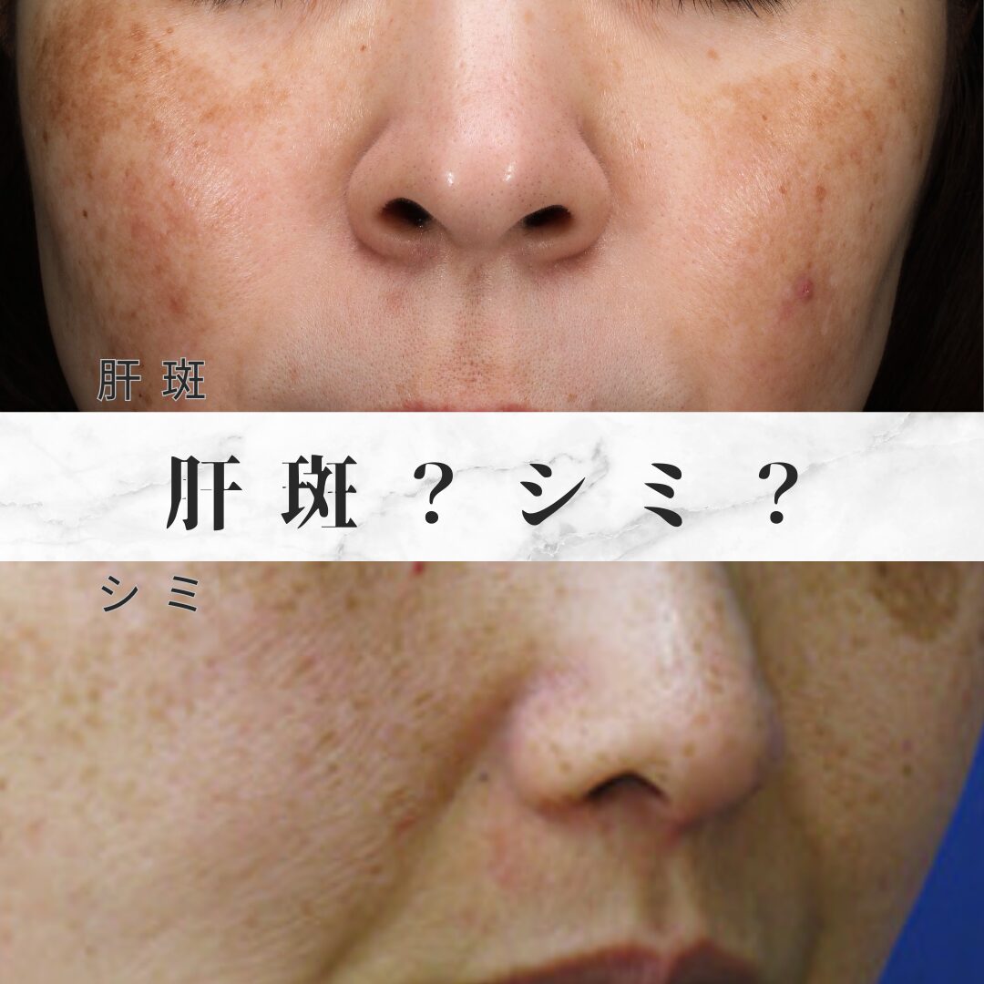 そのシミ実は肝斑？違いと見分け方・悪化を防ぐ2026年最新治療