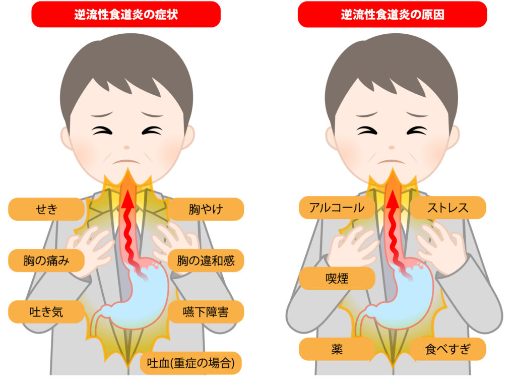 逆流性食道炎にバナナはダメ？胸焼けを招く罠と悪化を防ぐ新常識