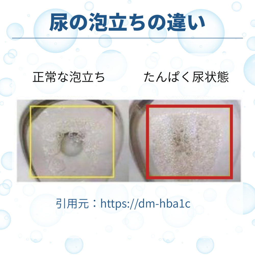 尿の泡立ちや甘い匂いは糖尿病？初期症状のサインと見逃せない危険信号