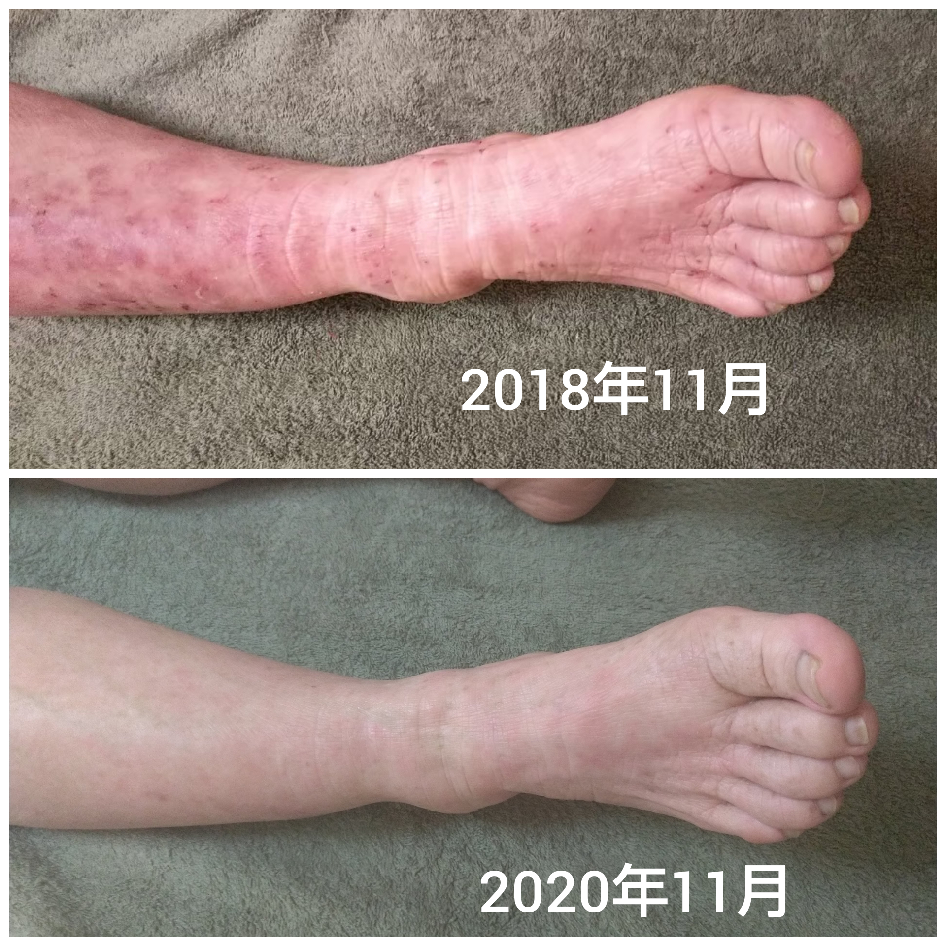 なぜアトピーは治らない？大人の悪化原因と2026年最新治療の真相