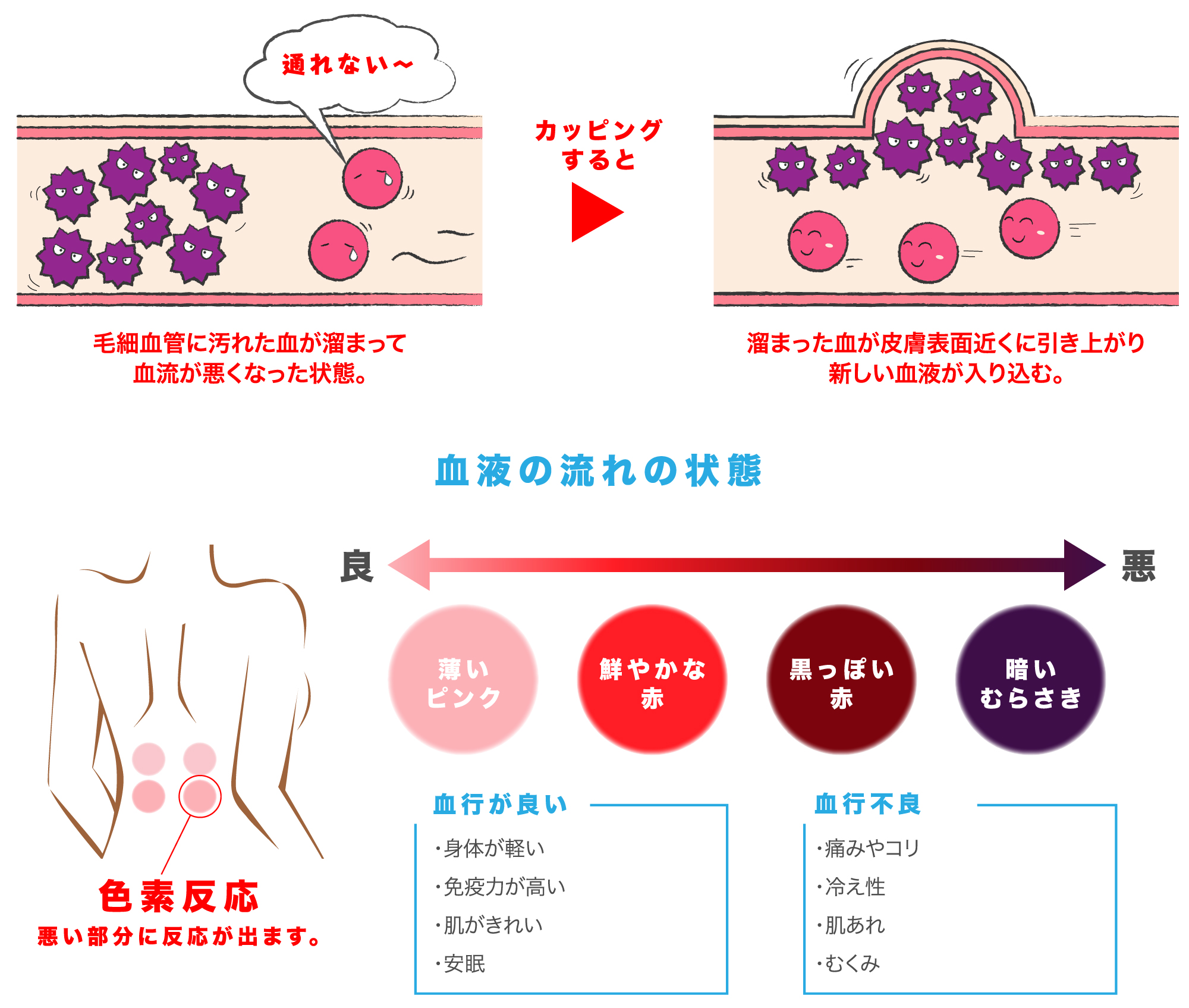 カッピングとは？効果や跡が消えない理由と色の意味を徹底解説