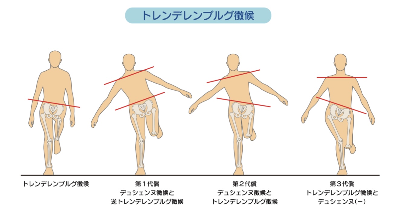 トレンデレンブルグ徴候の原因と判定基準｜デュシェンヌとの違いと対策