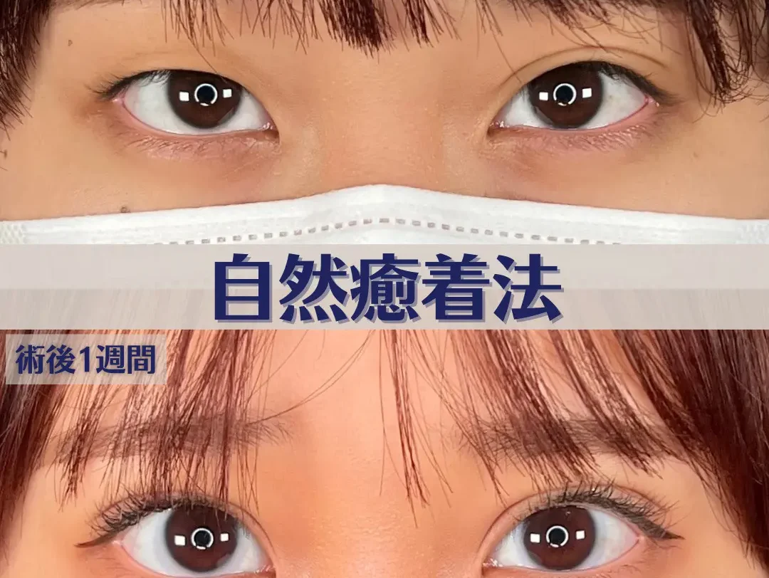 片目だけ二重の治し方と原因｜自力改善の限界から埋没法の費用相場まで徹底解説
