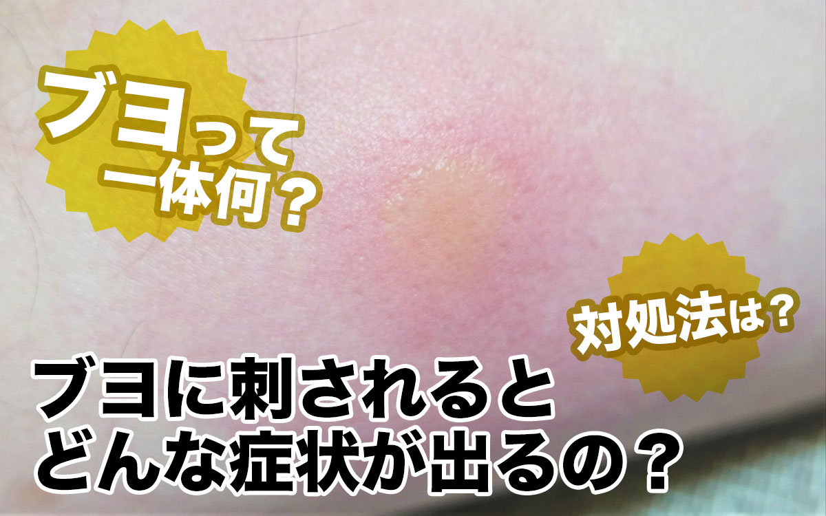 ブヨに刺されたら激痛と腫れはどう防ぐ？直後5分の応急処置と市販薬