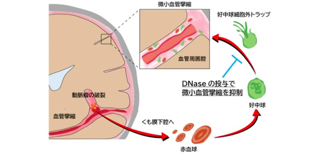 【2026年医療追跡】脳動脈瘤破裂の陰に潜むサイレント・キラー「脳血管攣縮」—劇症化のメカニズムと最新救命戦略の最前線