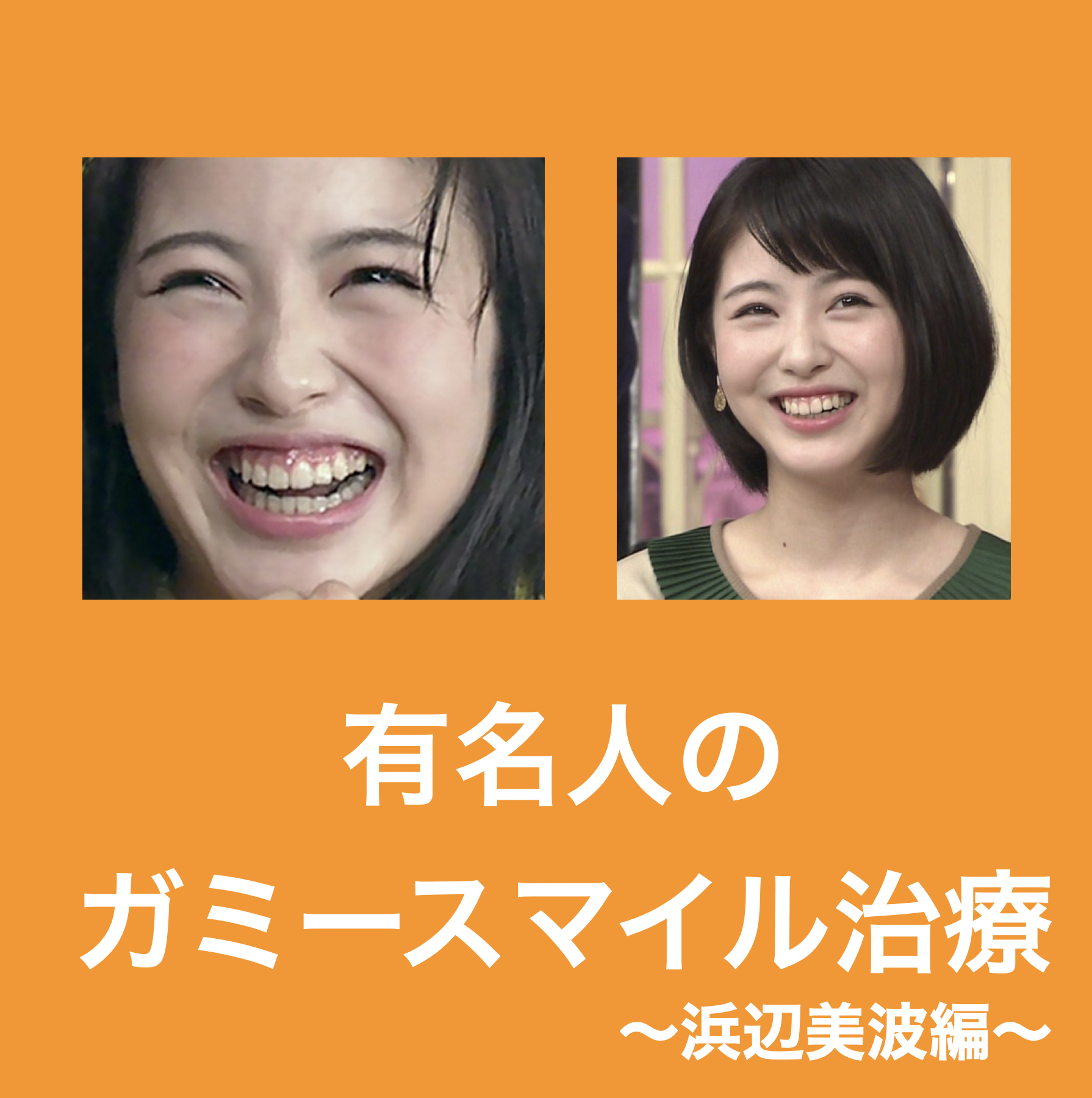 浜辺美波の歯並びはいつ変わった？矯正とセラミック治療の真相