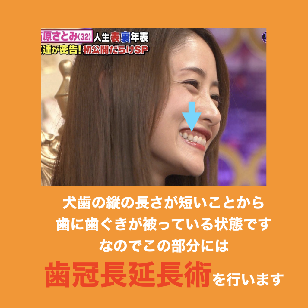 石原さとみの歯並び変化と垢抜けの真相！八重歯から理想の口元へ