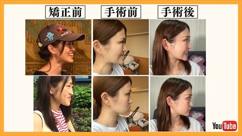 【真相】 顎 変形 症 手術 芸能人 話題のSns投稿まとめ 2026 #649