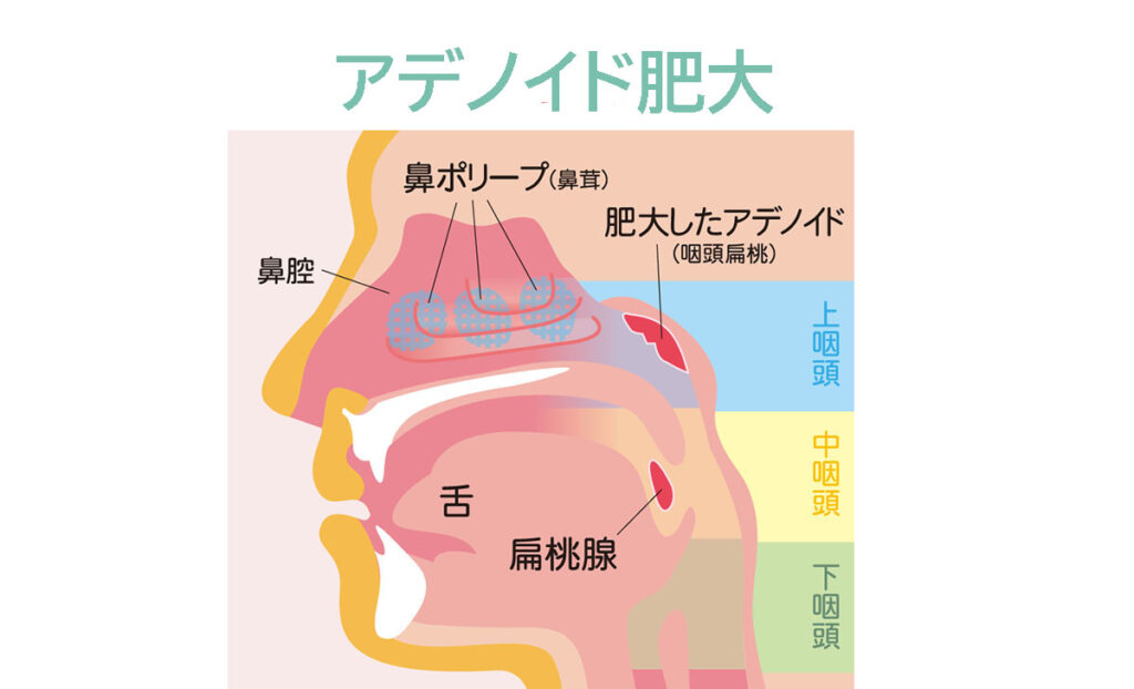 アデノイド顔貌と噂の芸能人の真相！劇的変化を遂げた決定打とは