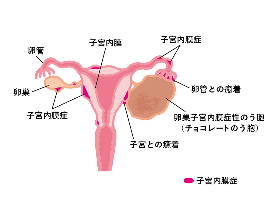 子宮内膜ポリープ手術のリアル｜痛み・麻酔・費用と術後経過の全真相