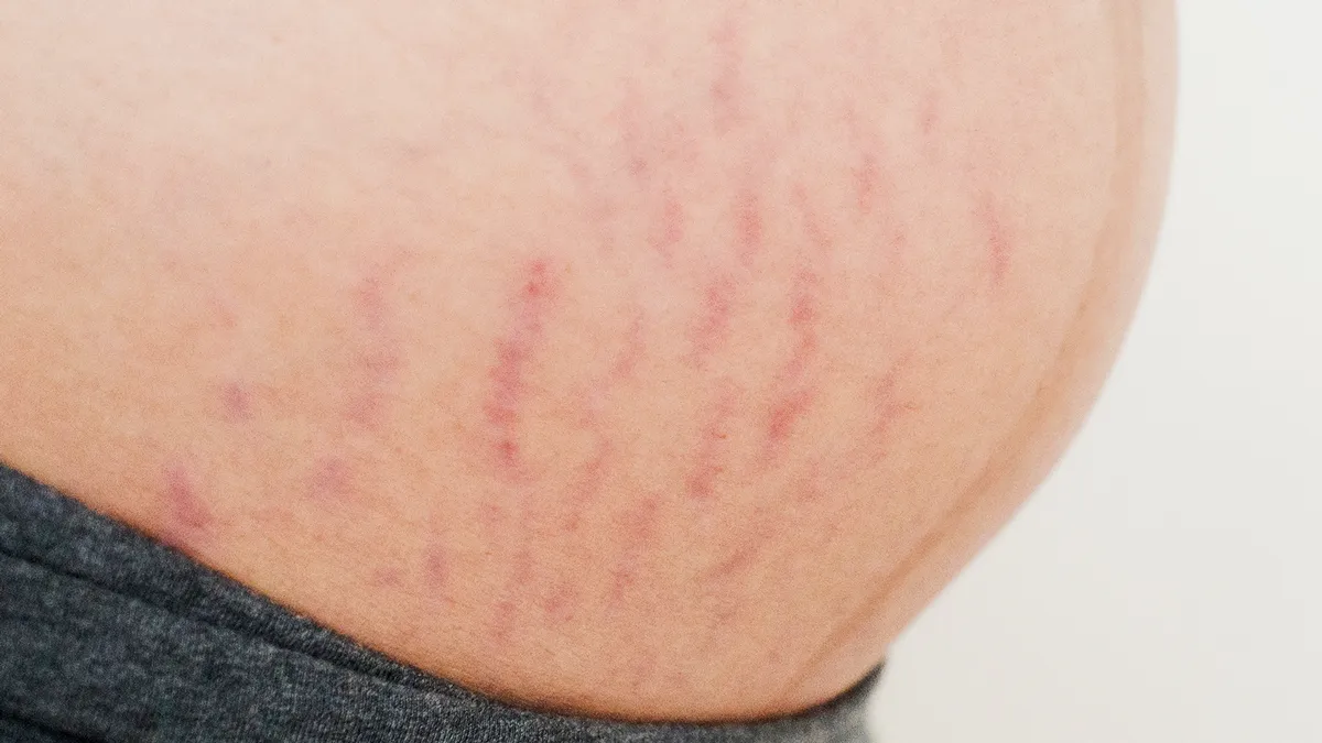 肉割れは自力で治る？赤と白の決定的な違いと専門医が明かす最新ケア