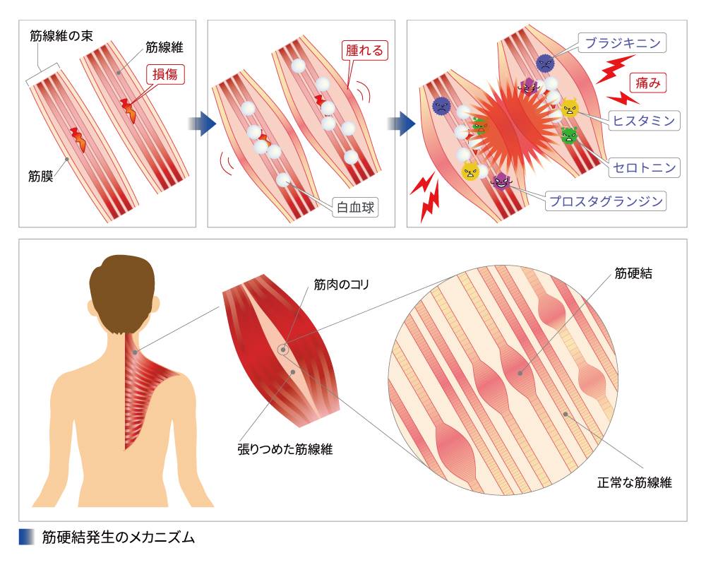 筋肉の謎のしこり「筋硬結とは」？放置Ngな理由と最新のほぐし方を徹底解説