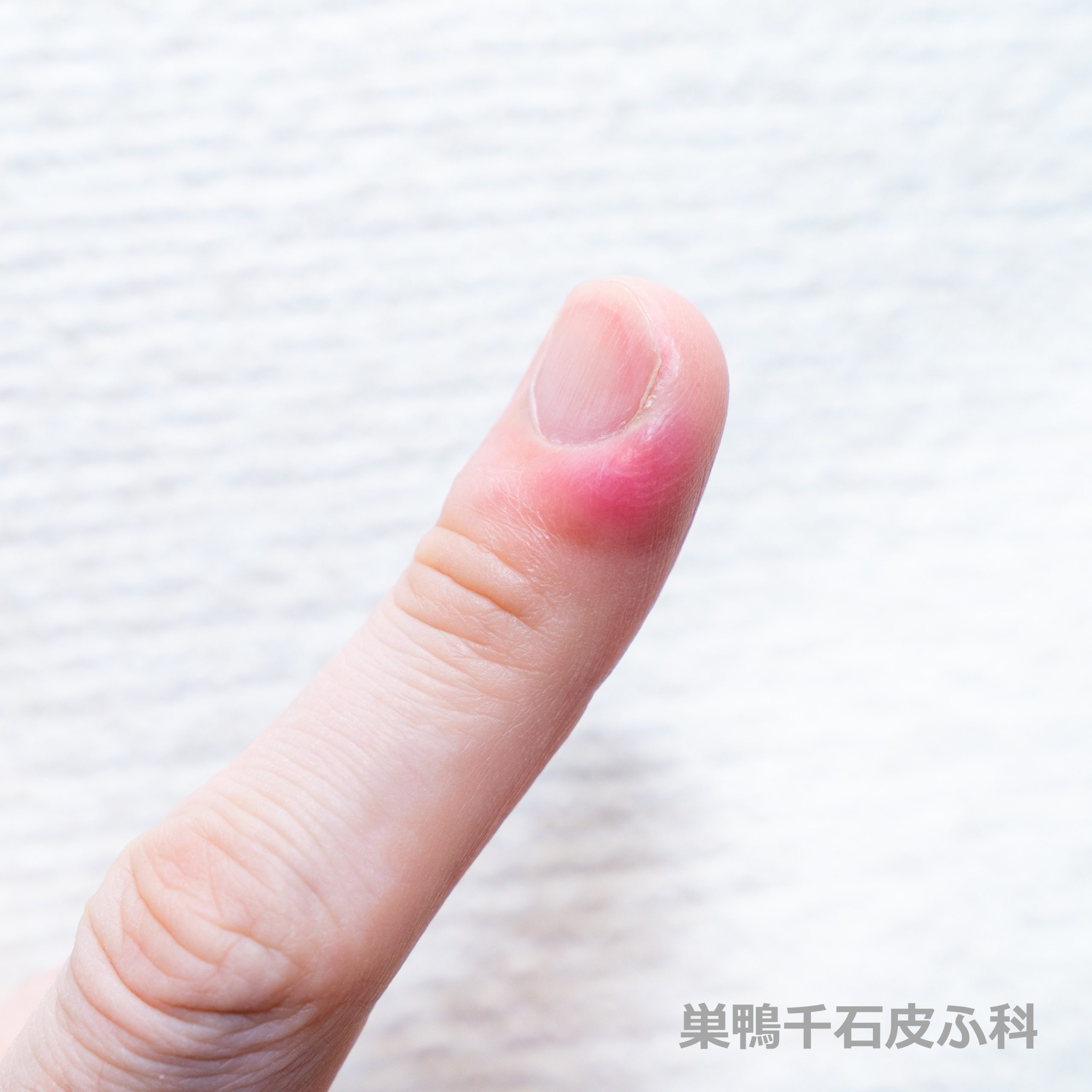 指が腫れて痛い原因と危険サイン｜受診すべき科と最新対処法