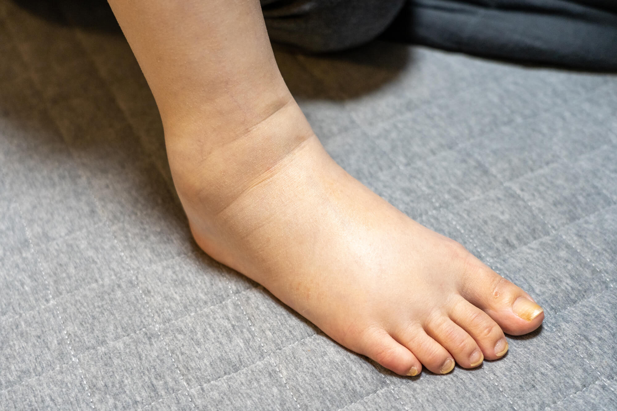 手足のむくみは重大な病気の前兆？見逃せない危険なサインと受診科一覧