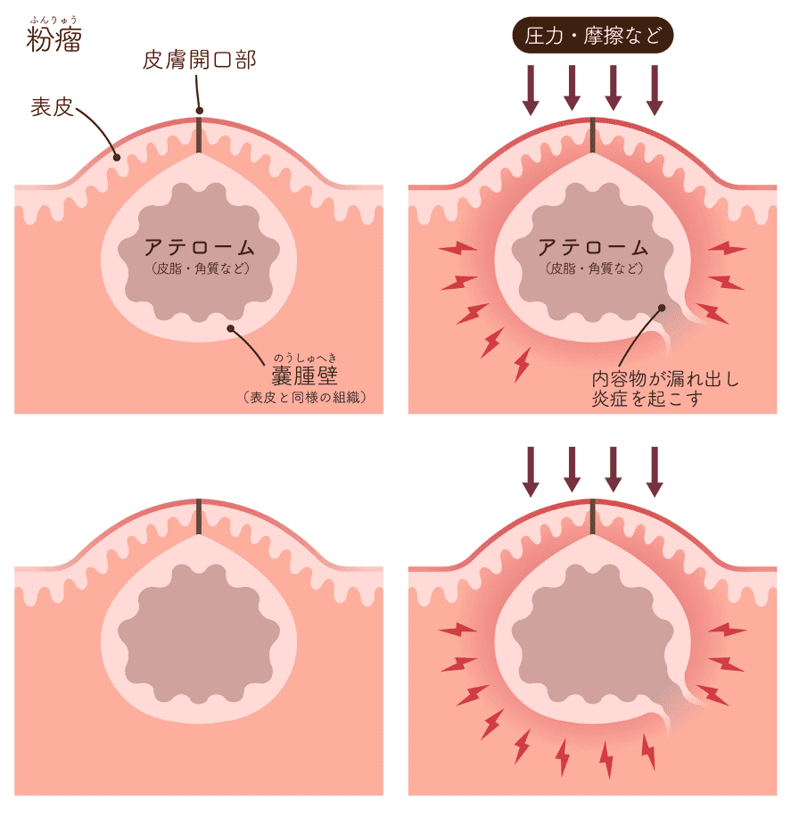 脂肪腫は何科？皮膚科より形成外科が推奨される決定的な理由と治療実態