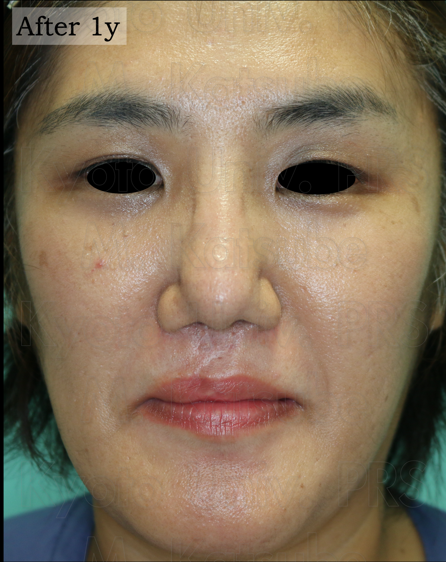 大人の口唇口蓋裂は今から間に合う？修正手術と保険・費用を徹底解説