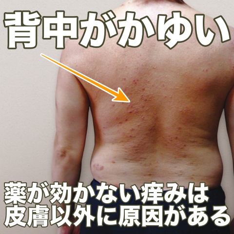 【インスタ画像】 背中 の かゆみ 肝臓 ファン必見の最新情報 #669