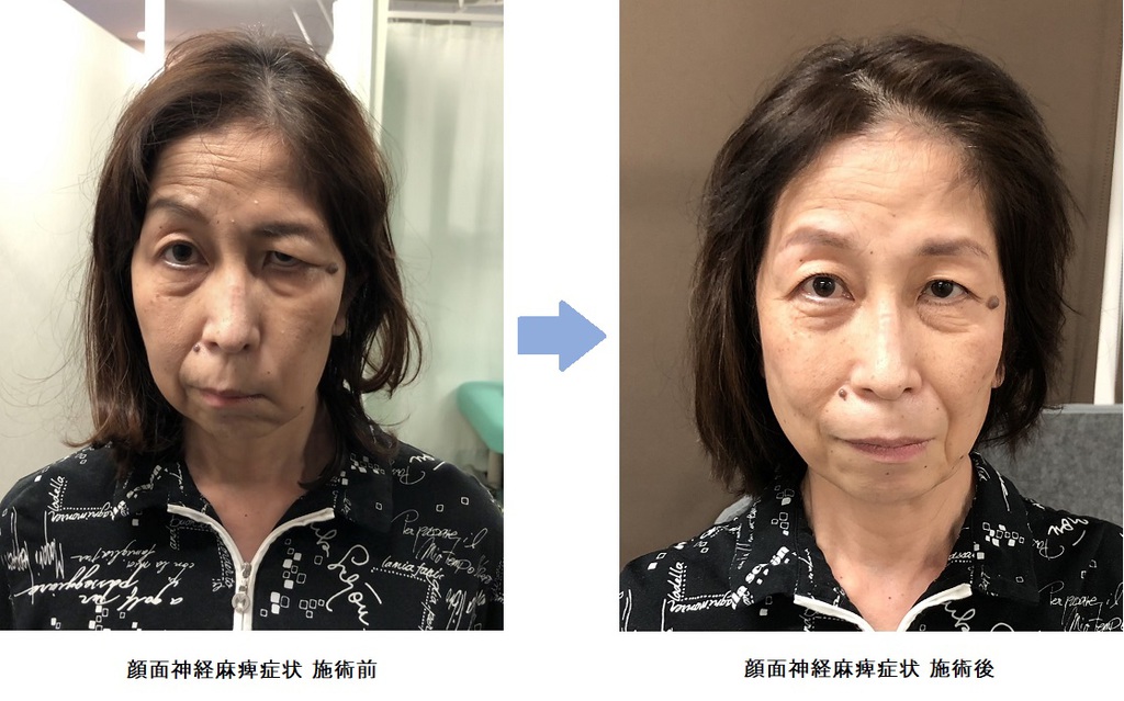顔面神経麻痺を公表した芸能人の現在と後遺症の真相｜2026年最新動向