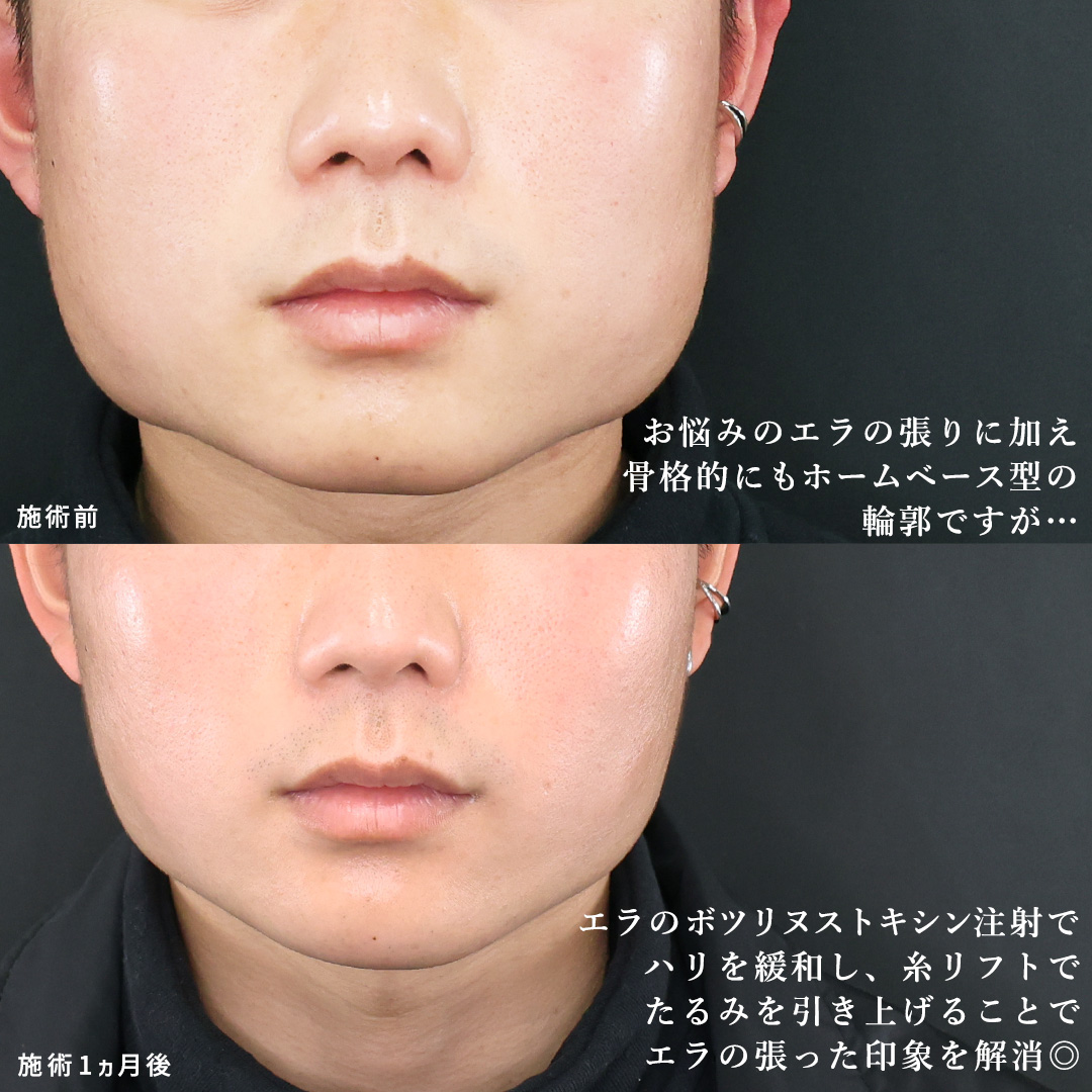 エラ張りは自分で矯正できる？骨格と筋肉の見分け方＆即効ほぐし術